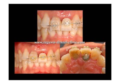 早期埋入の術前術後イメージ例4（田川歯科）